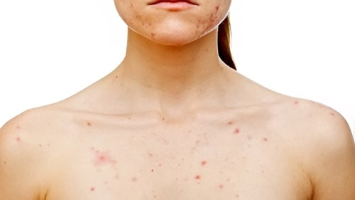 chest acne