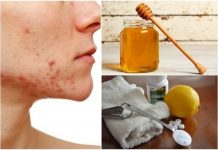 Get Rid Of Cystic Acne