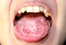 candidiasis