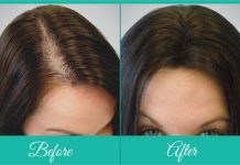 Hair Restoration Techniques