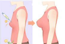 fat transfer a good alternative to breast implants