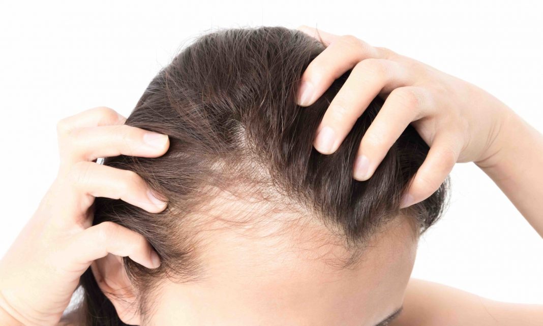 Hair Loss and Hormonal Imbalance in Women BeautyOnFleeck