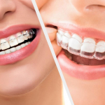 tauntonorthodontics-why-orthodontic-treatment-is-important